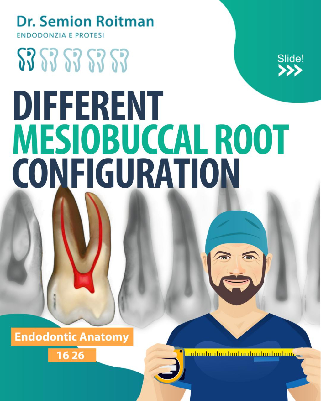 Different mesiobuccal root configuration